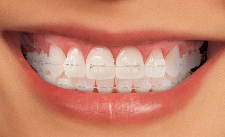 Chi phí niềng răng hô phương pháp mắc cài sứ